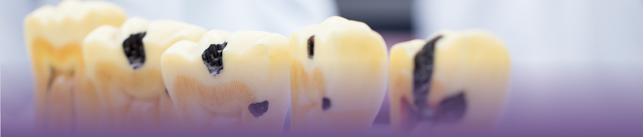 Model of a row of severely decayed teeth