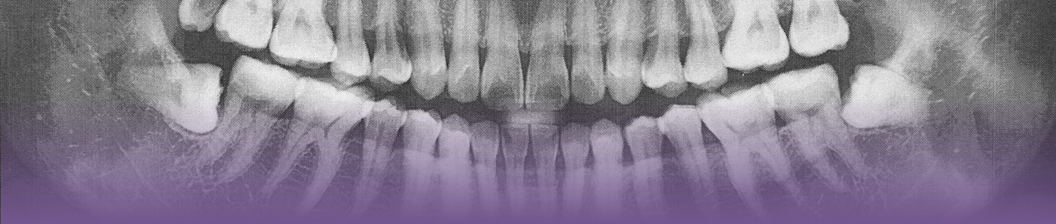 X ray of impacted wisdom teeth pressing against the adjacent teeth